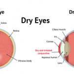 Dry Eyes Follow Some Useful Home Remedies
