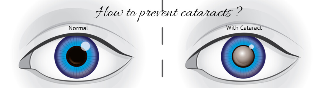 Protect Your Vision & Prevent Cataracts With Dietary & Lifestyle Changes