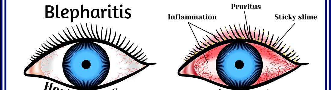 Blepharitis – How You Can Naturally Treat Eyelid Inflammation?
