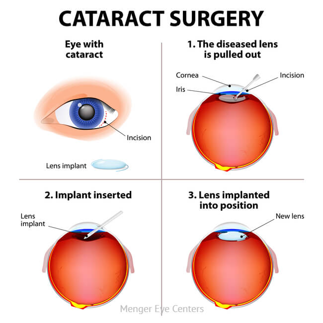 Eye With Cataract