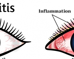 Blepharitis – How You Can Naturally Treat Eyelid Inflammation?