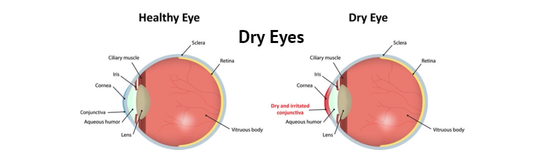 Treatment Of Dry Eyes – Follow Some Useful Home Remedies