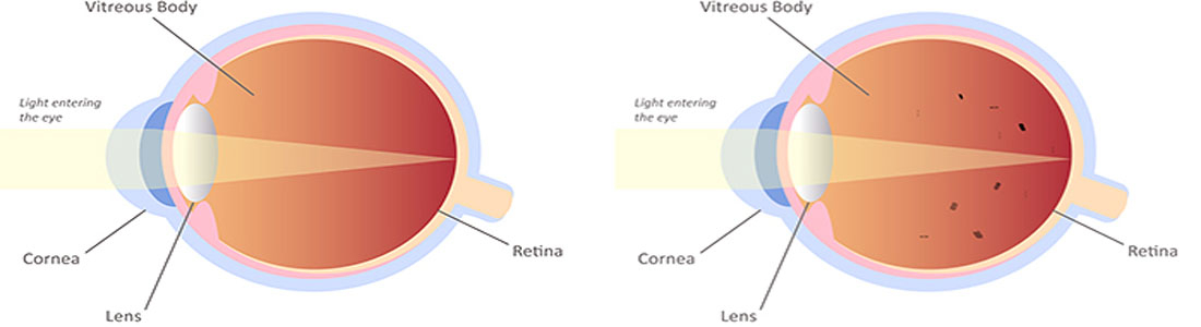 Facts about Vitreous Eye Floaters – Symptoms, Causes, Diagnosis & Treatment
