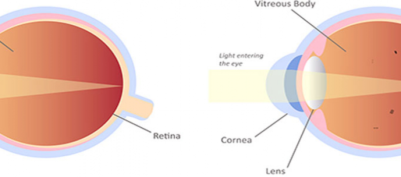 Facts about Vitreous Eye Floaters – Symptoms, Causes, Diagnosis & Treatment
